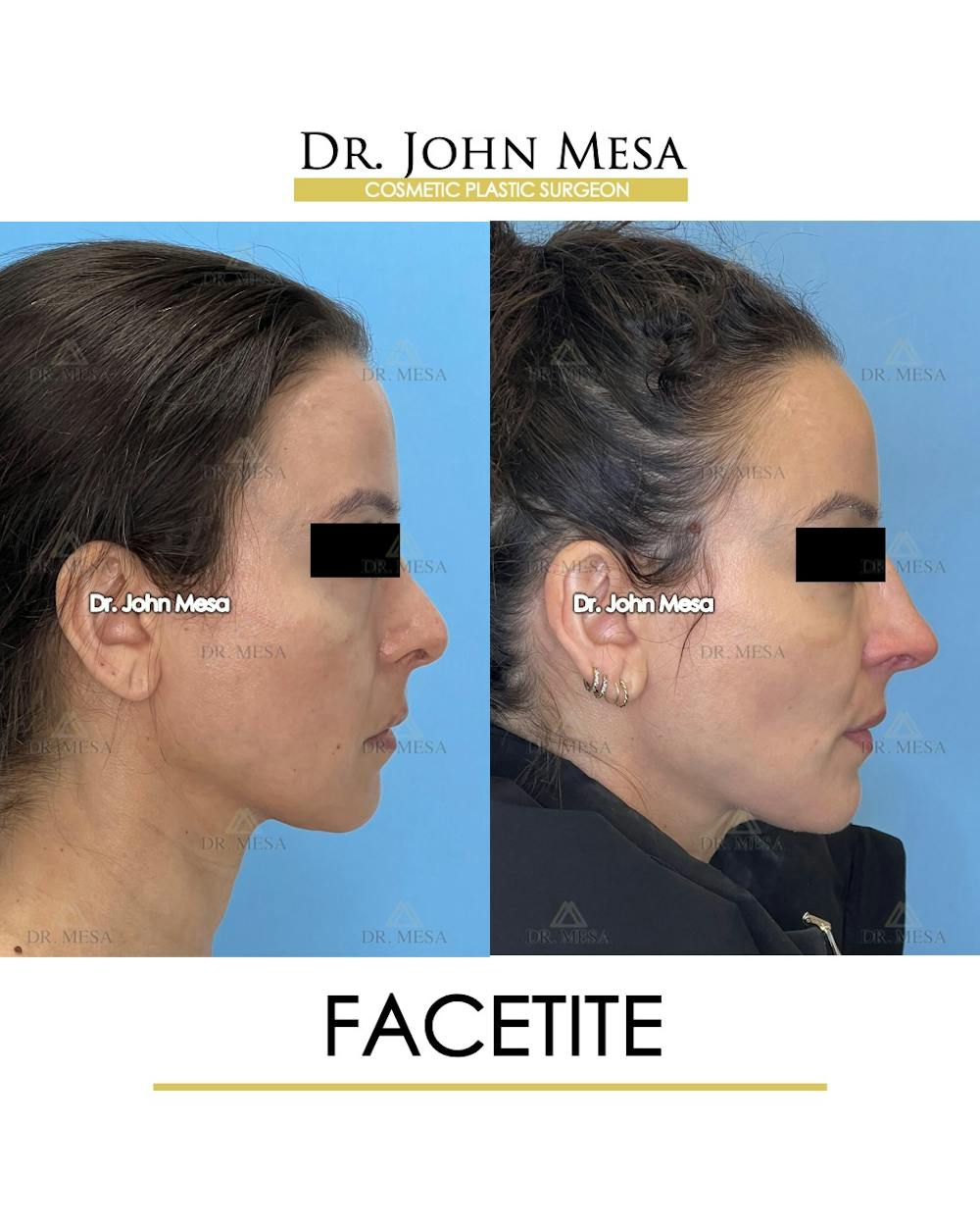 FaceTite Before & After Gallery - Patient 246520 - Image 3