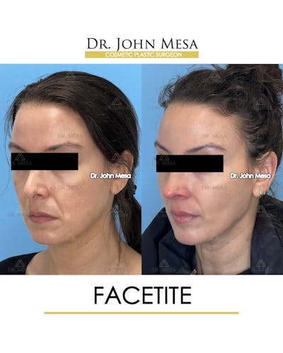 FaceTite Before & After Gallery - Patient 246520 - Image 4