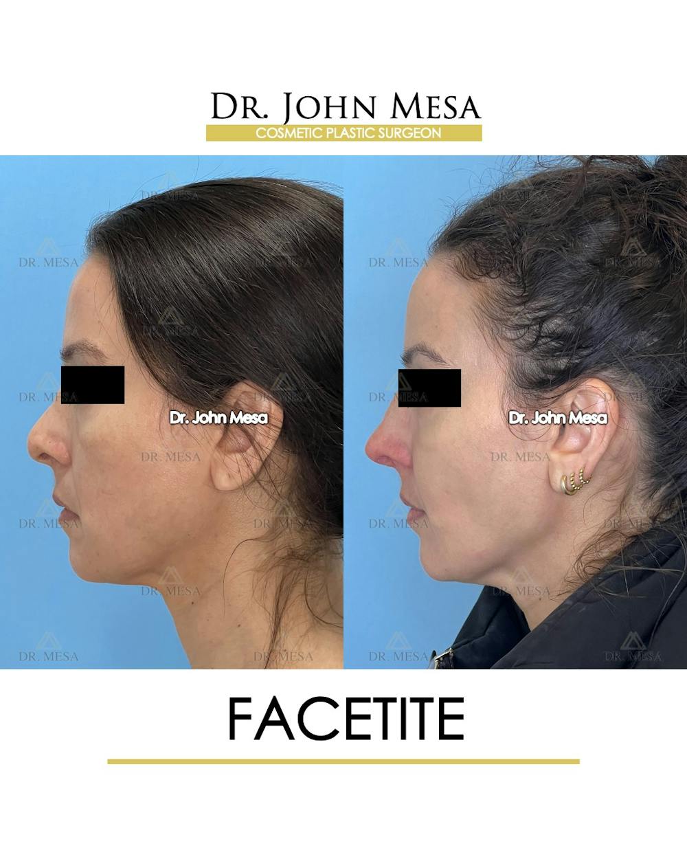 FaceTite Before & After Gallery - Patient 246520 - Image 5