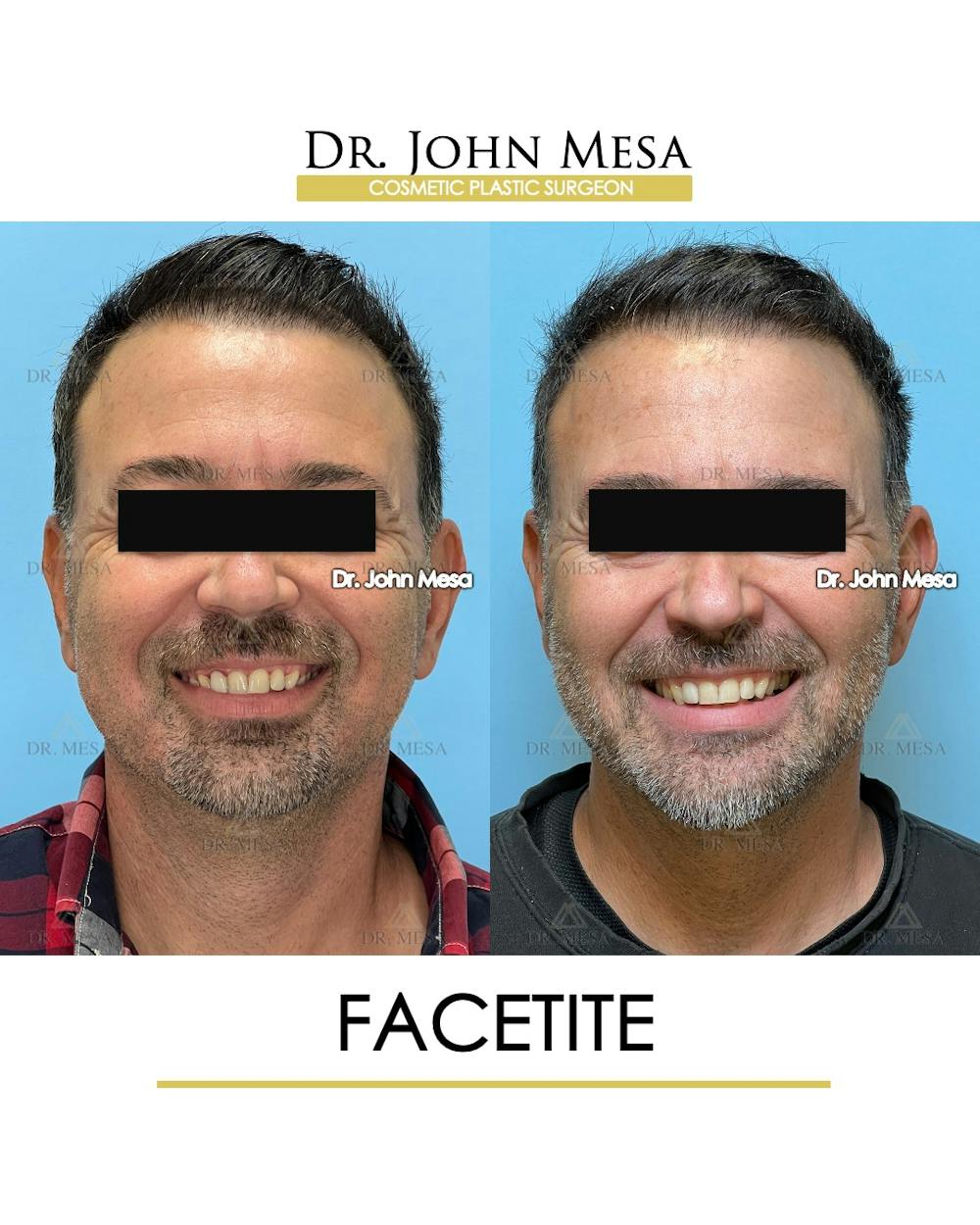 FaceTite Before & After Gallery - Patient 348554 - Image 2
