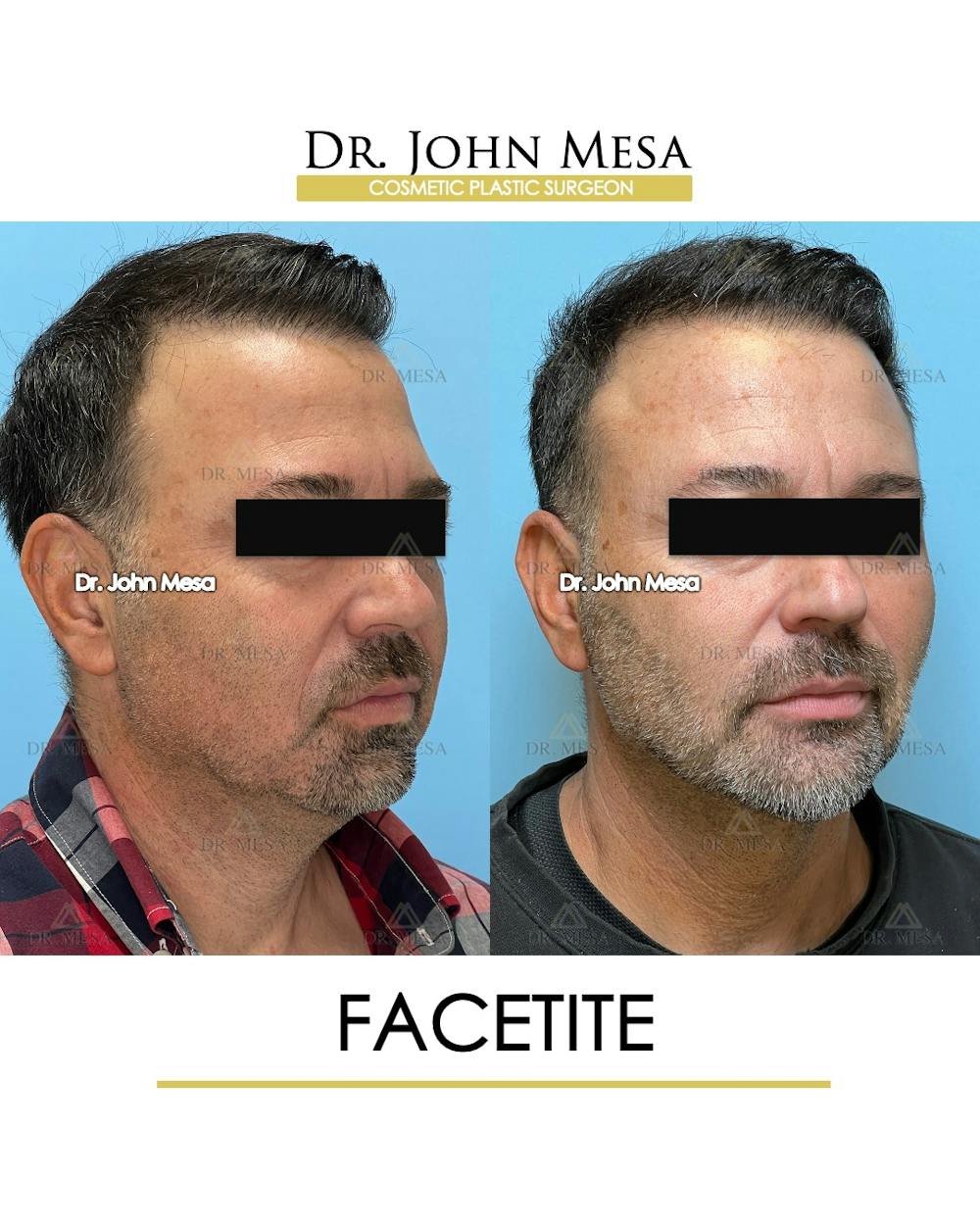 FaceTite Before & After Gallery - Patient 348554 - Image 3