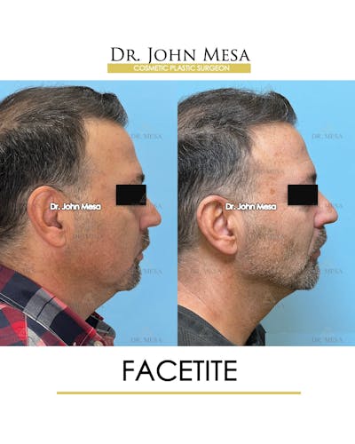 FaceTite Before & After Gallery - Patient 348554 - Image 4