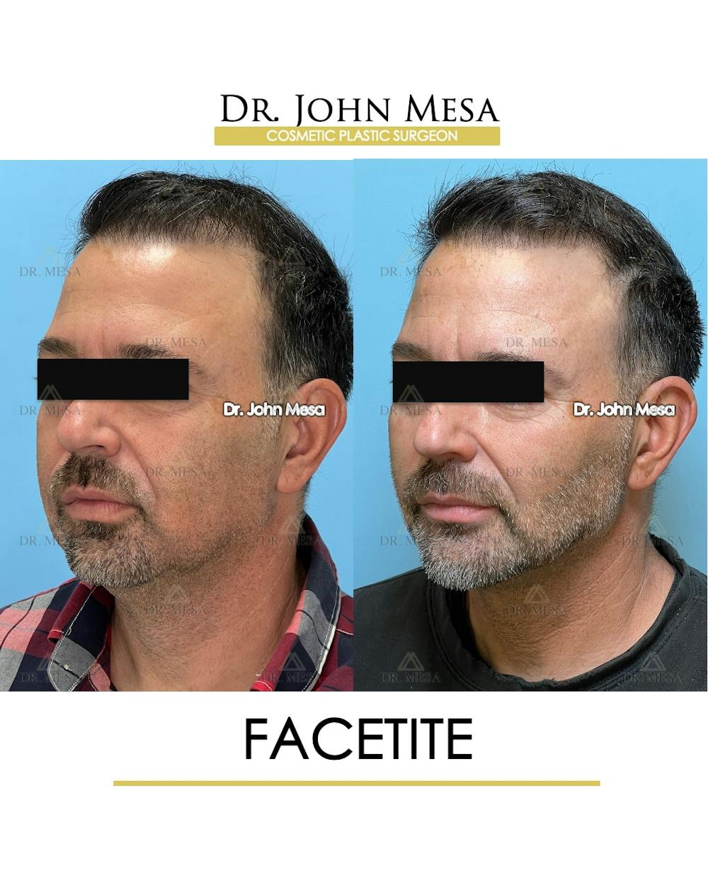 FaceTite Before & After Gallery - Patient 348554 - Image 5