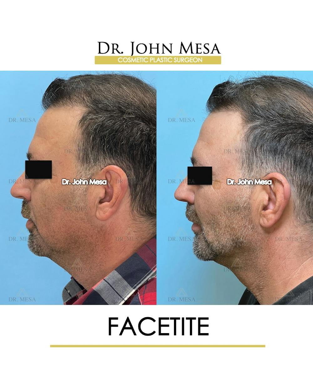 FaceTite Before & After Gallery - Patient 348554 - Image 6