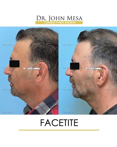FaceTite Before & After Gallery - Patient 348554 - Image 6