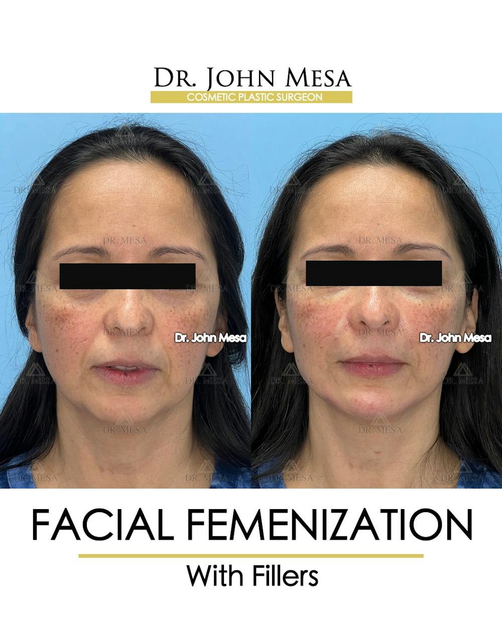 Facial Feminization Before & After Gallery - Patient 811244 - Image 1