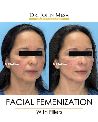 Facial Feminization Before & After Gallery - Patient 811244 - Image 2