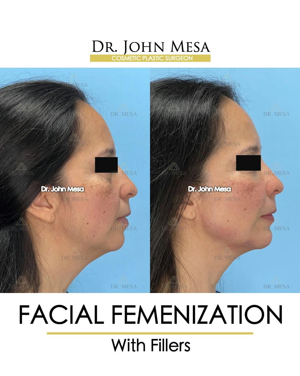 Facial Feminization Before & After Gallery - Patient 811244 - Image 3