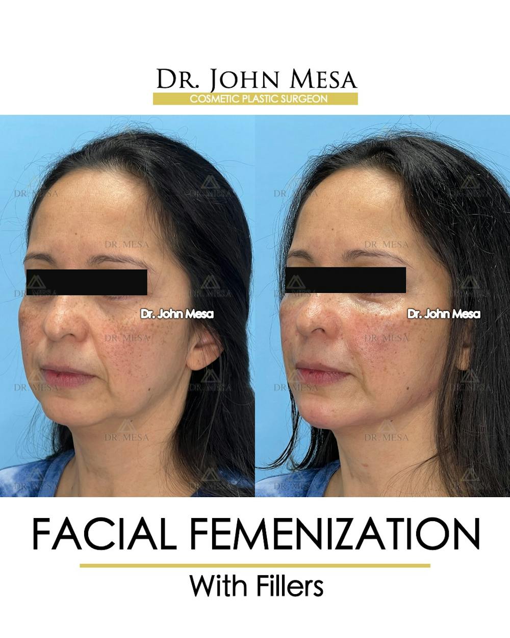 Facial Feminization Before & After Gallery - Patient 811244 - Image 4