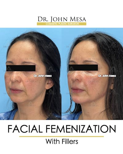 Facial Feminization Before & After Gallery - Patient 811244 - Image 4