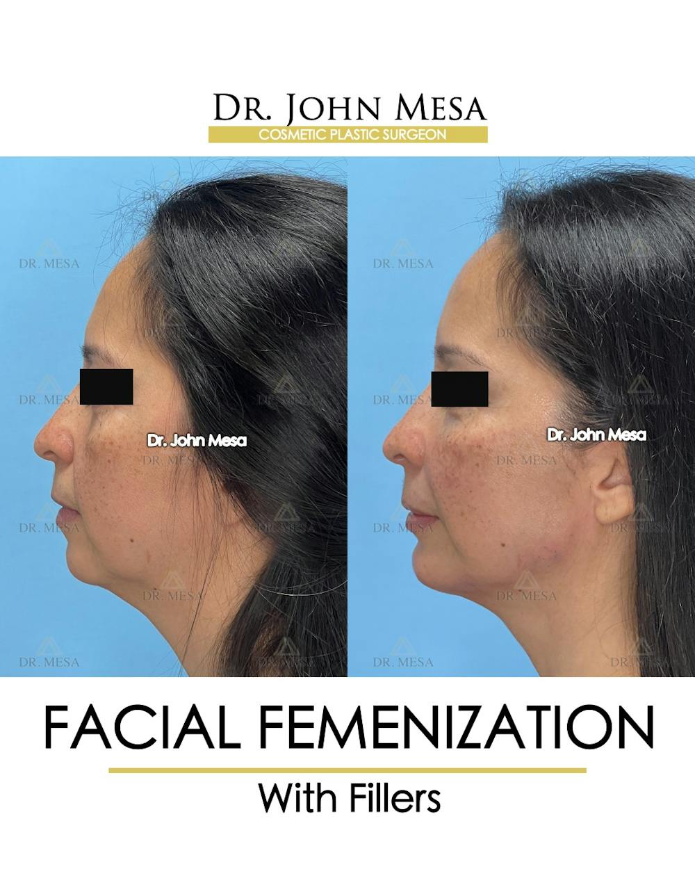Facial Feminization Before & After Gallery - Patient 811244 - Image 5