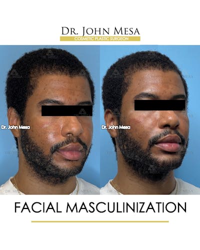 Facial Masculinization Before & After Gallery - Patient 395926 - Image 2