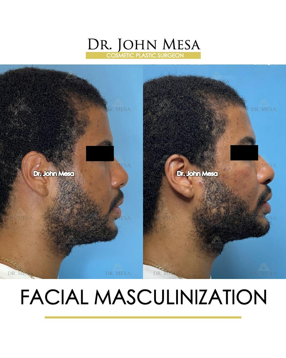 Facial Masculinization Before & After Gallery - Patient 395926 - Image 3