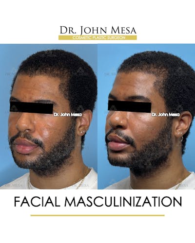 Facial Masculinization Before & After Gallery - Patient 395926 - Image 4