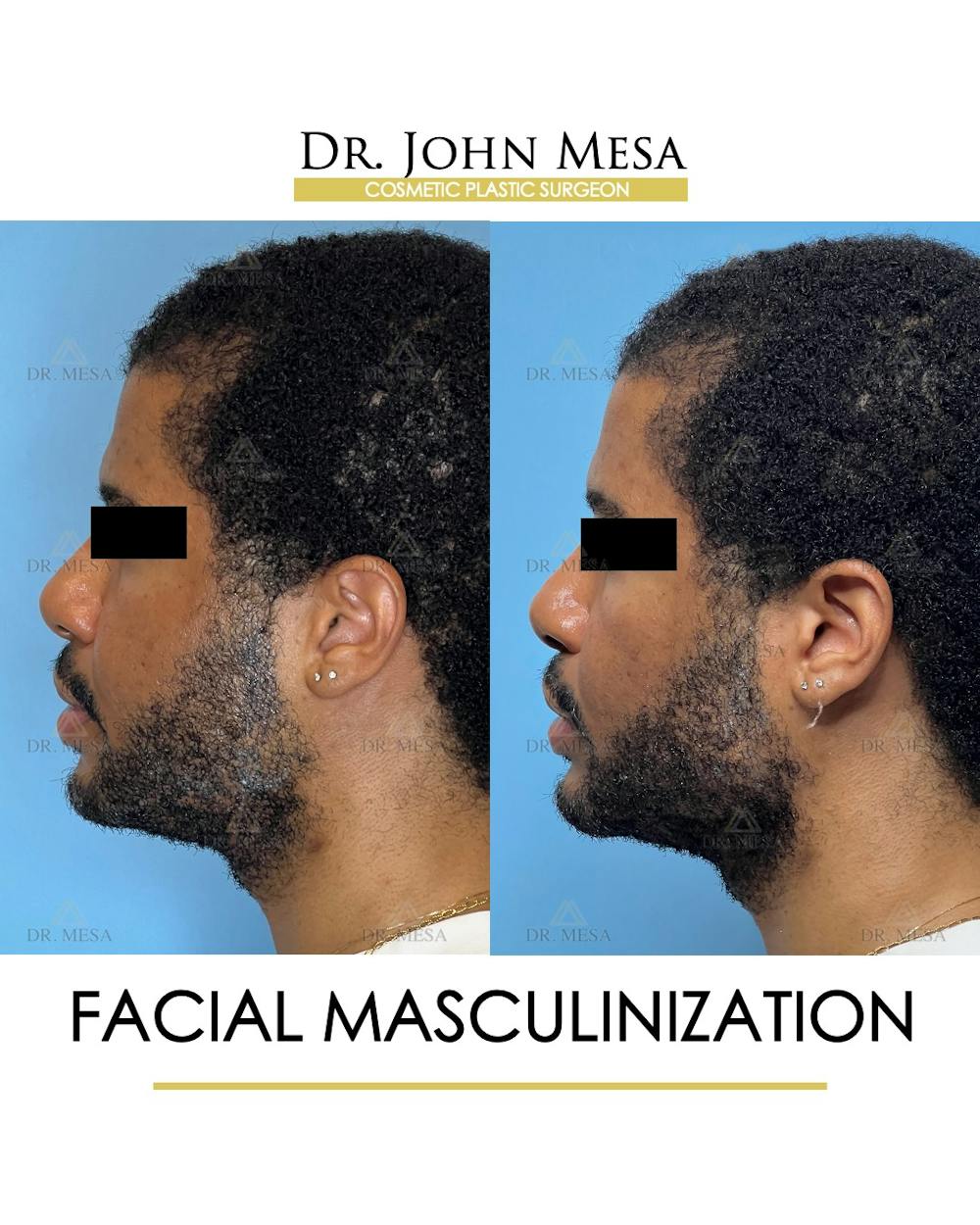 Facial Masculinization Before & After Gallery - Patient 395926 - Image 5