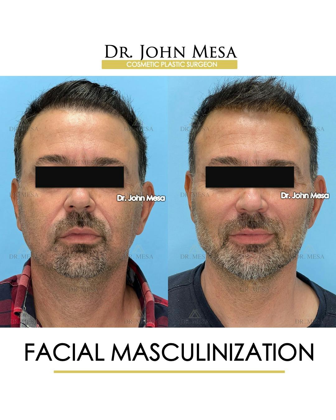 Facial Masculinization Before & After Photos Dr. Mesa