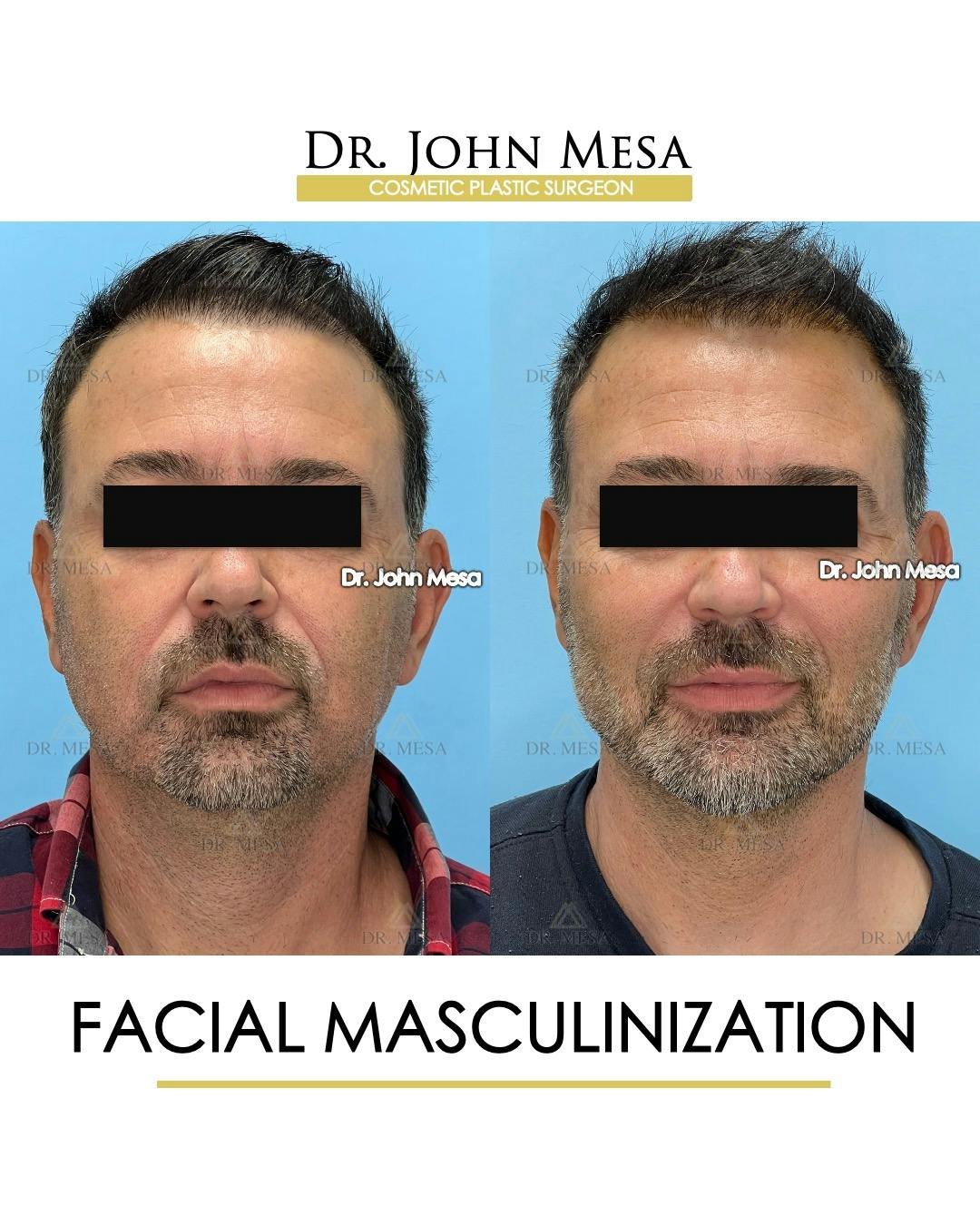 Facial Masculinization Before & After Gallery - Patient 225000 - Image 1