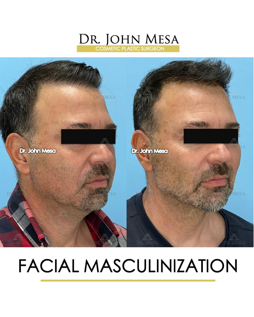 Facial Masculinization Before & After Gallery - Patient 225000 - Image 2