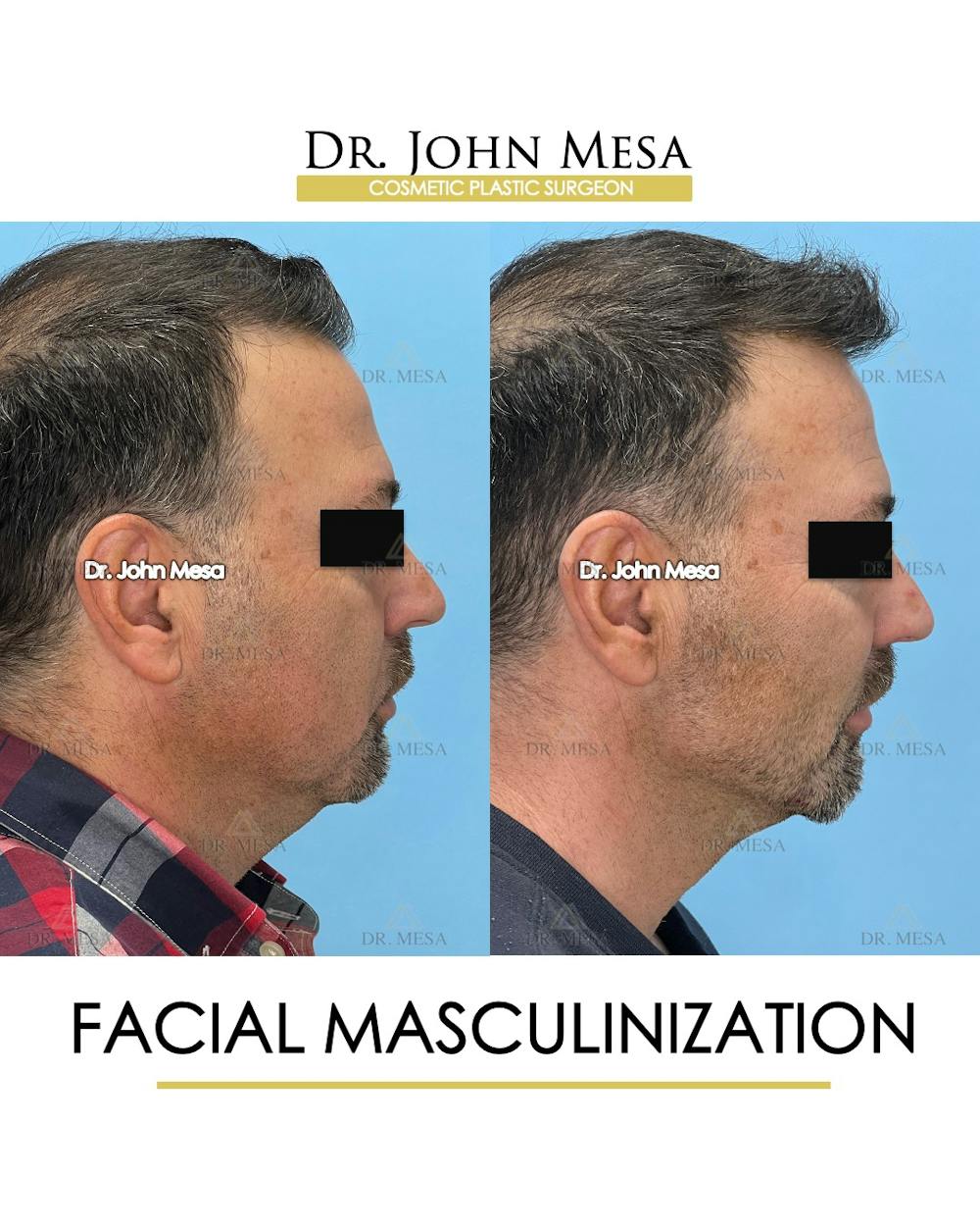 Facial Masculinization Before & After Gallery - Patient 225000 - Image 3