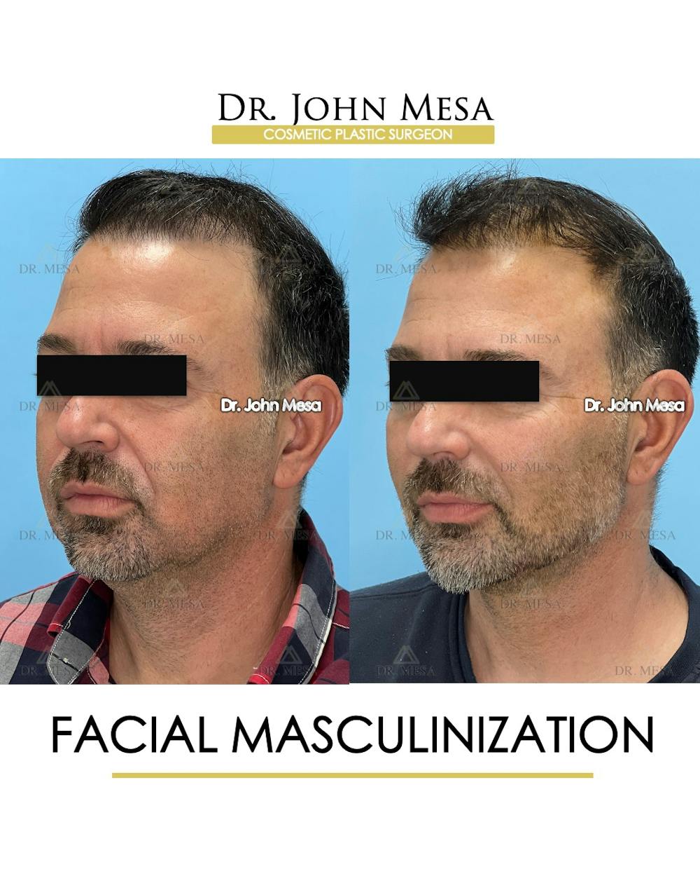 Facial Masculinization Before & After Gallery - Patient 225000 - Image 4