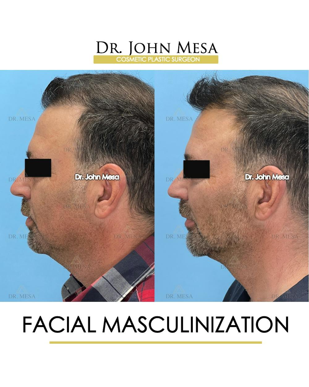 Facial Masculinization Before & After Gallery - Patient 225000 - Image 5
