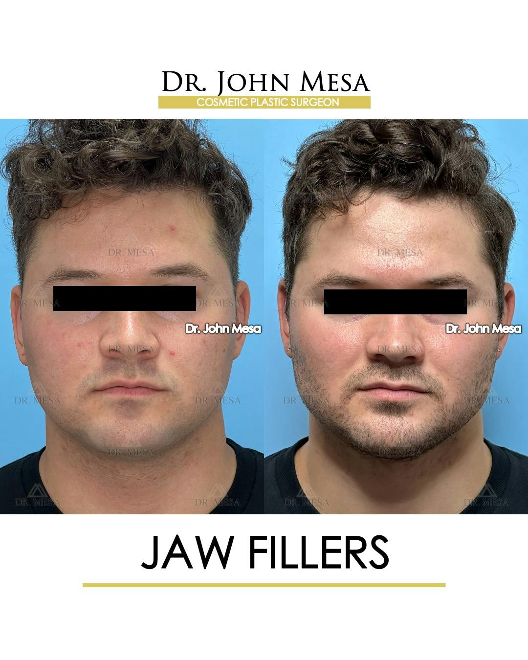 Jaw Filler Before & After Gallery - Patient 410263 - Image 1