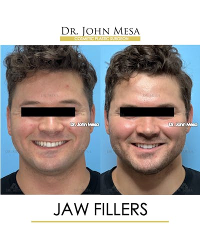 Jaw Filler Before & After Gallery - Patient 410263 - Image 2