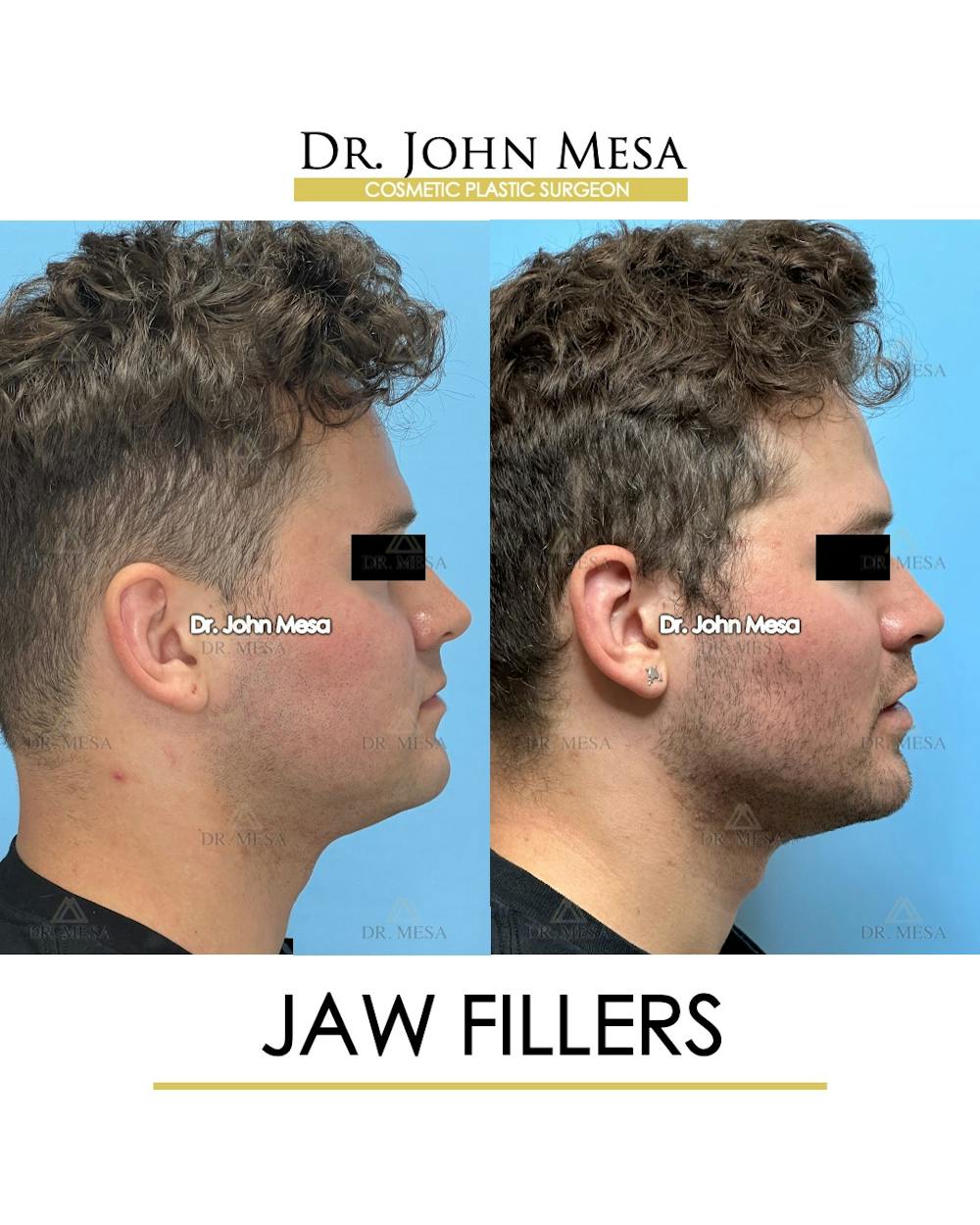 Jaw Filler Before & After Gallery - Patient 410263 - Image 4