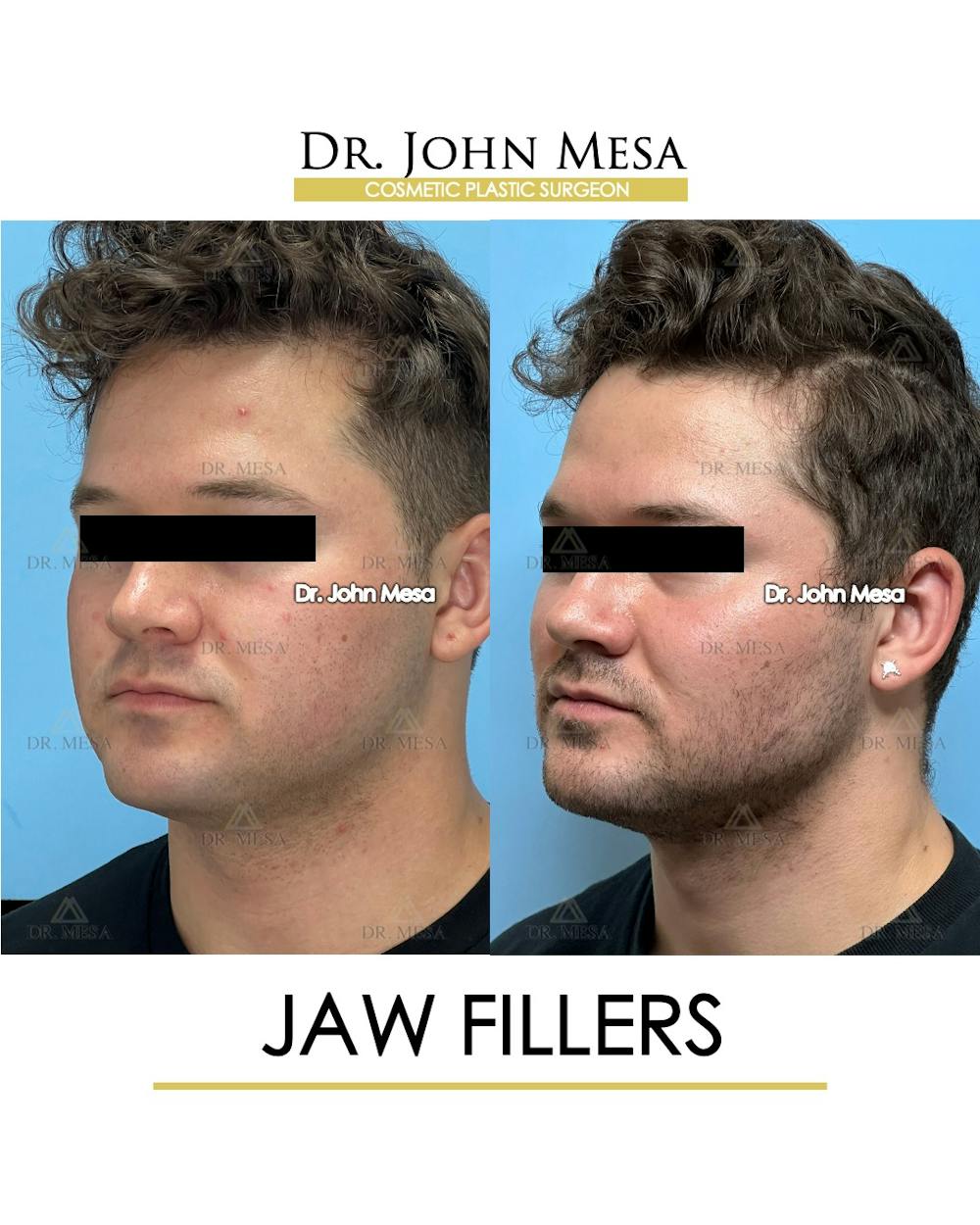 Jaw Filler Before & After Gallery - Patient 410263 - Image 5