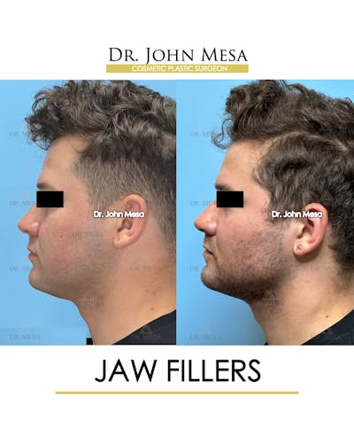 Jaw Filler Before & After Gallery - Patient 410263 - Image 6