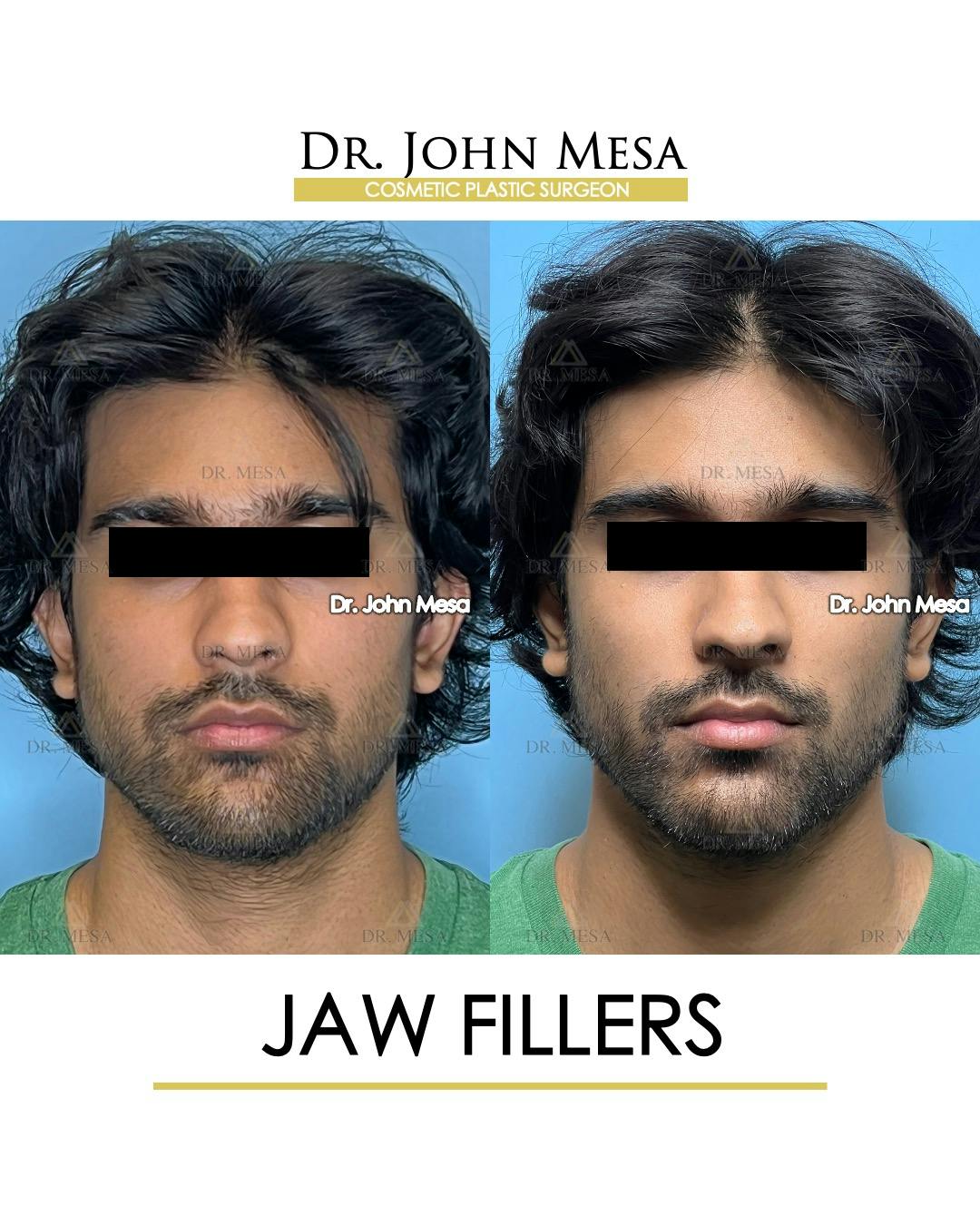 Jaw Filler Before & After Gallery - Patient 105600 - Image 1