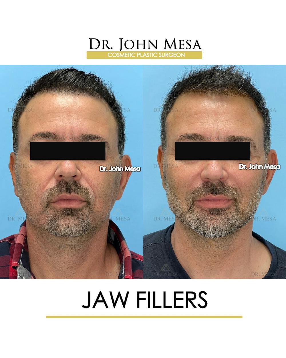 Jaw Filler Before & After Gallery - Patient 144676 - Image 1