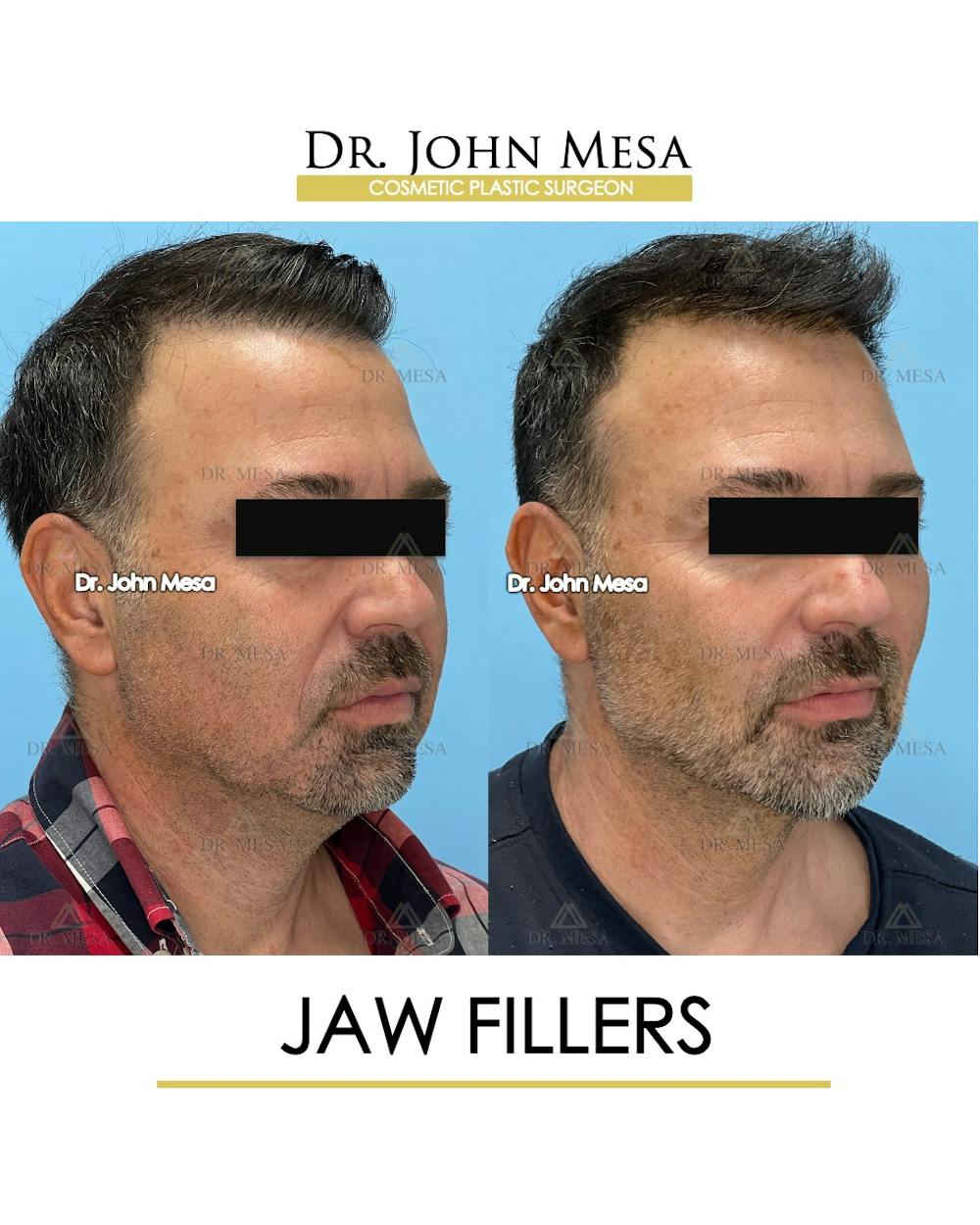 Jaw Filler Before & After Gallery - Patient 144676 - Image 2