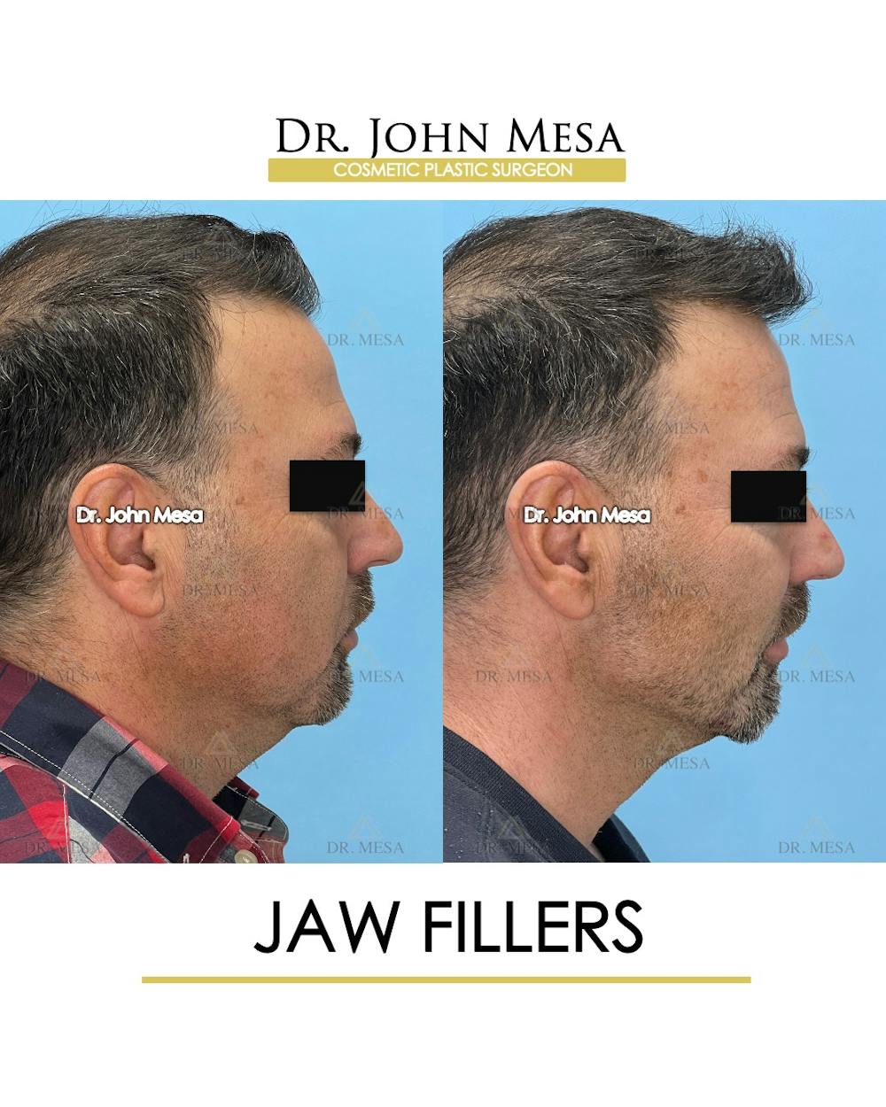 Jaw Filler Before & After Gallery - Patient 144676 - Image 3