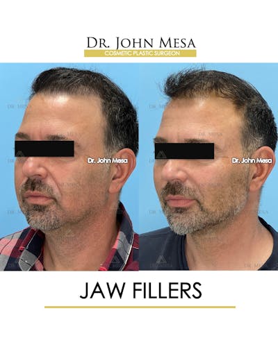 Jaw Filler Before & After Gallery - Patient 144676 - Image 4