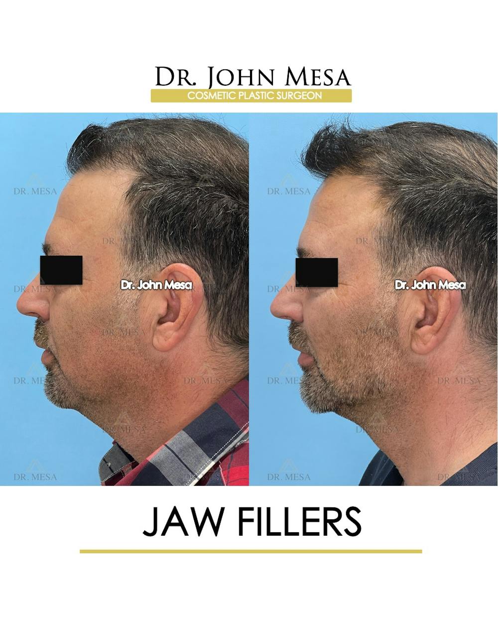 Jaw Filler Before & After Gallery - Patient 144676 - Image 5