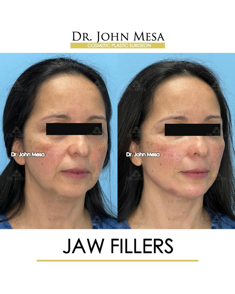 Jaw Filler Before & After Gallery - Patient 410029 - Image 2