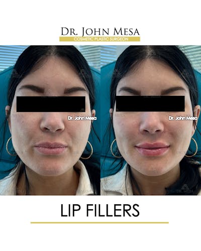 Lip Augmentation (Injectables) Before & After Gallery - Patient 660458 - Image 1