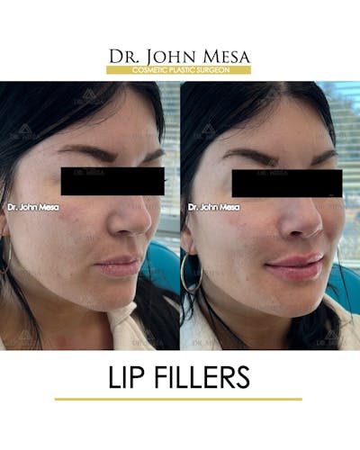 Lip Augmentation (Injectables) Before & After Gallery - Patient 660458 - Image 2