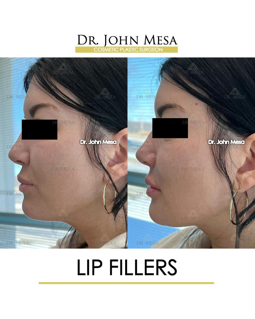 Lip Augmentation (Injectables) Before & After Gallery - Patient 660458 - Image 3