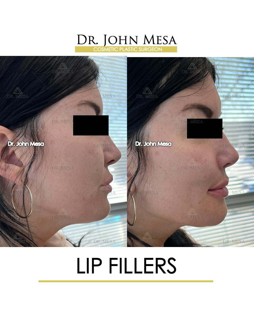 Lip Augmentation (Injectables) Before & After Gallery - Patient 660458 - Image 4