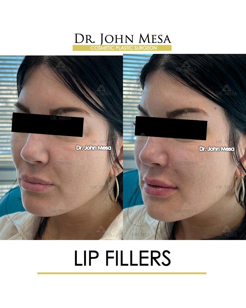 Lip Augmentation (Injectables) Before & After Gallery - Patient 660458 - Image 5