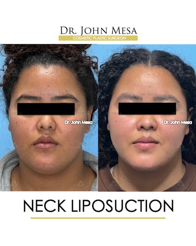 Neck Liposuction Before & After Gallery - Patient 182230 - Image 1