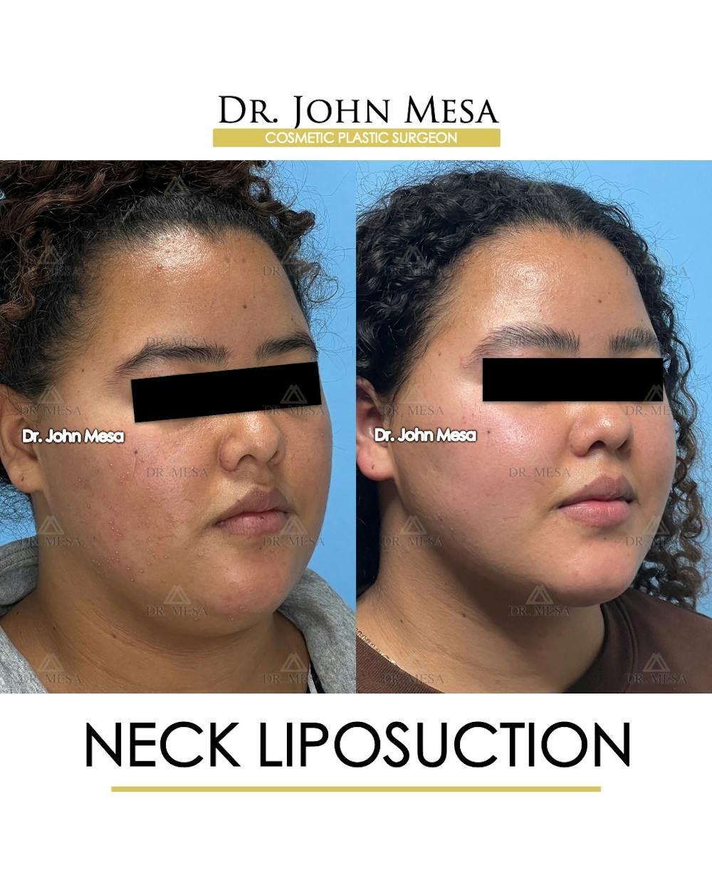 Neck Liposuction Before & After Gallery - Patient 182230 - Image 2