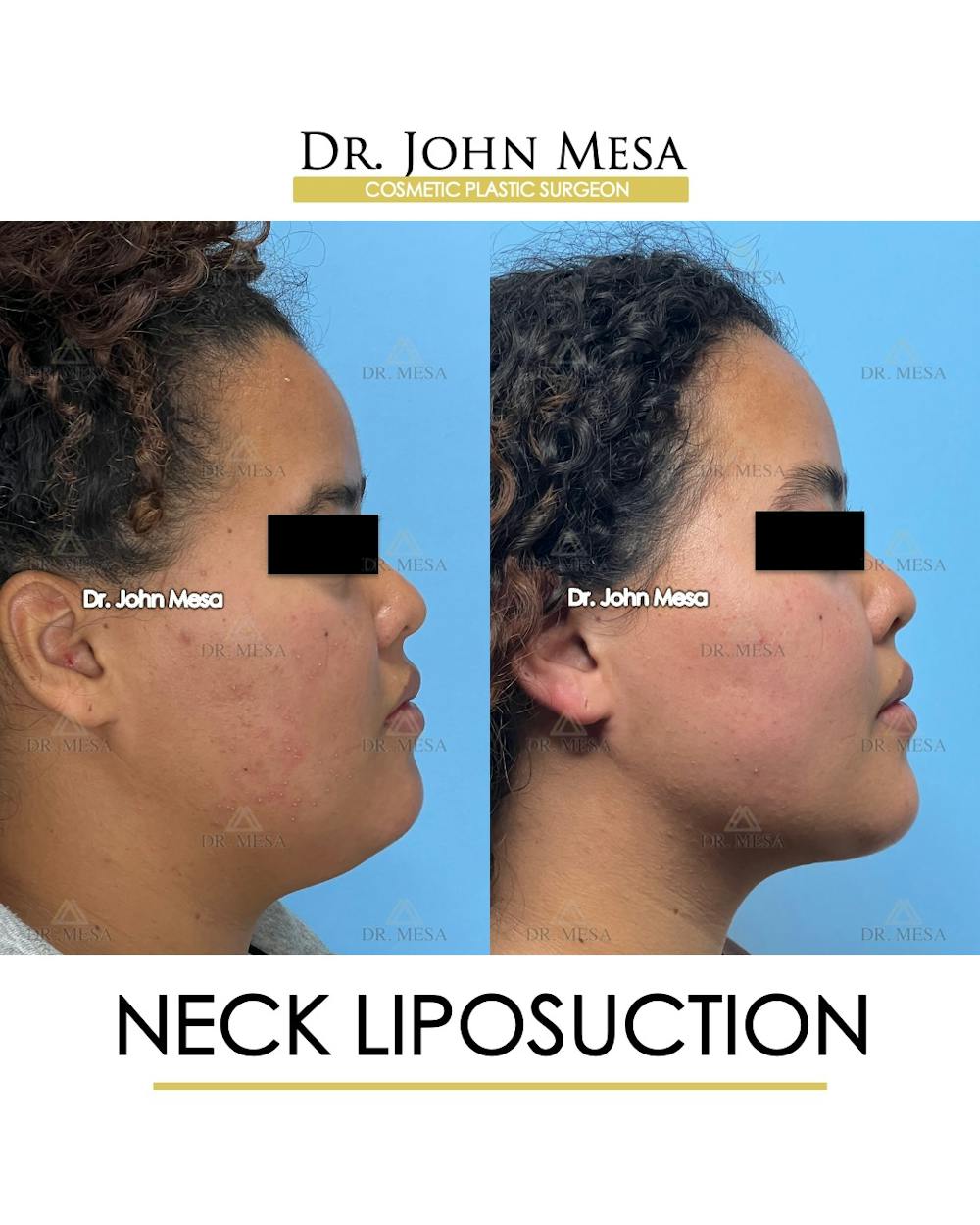 Neck Liposuction Before & After Gallery - Patient 182230 - Image 3