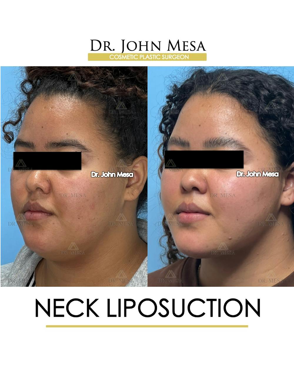 Neck Liposuction Before & After Gallery - Patient 182230 - Image 4