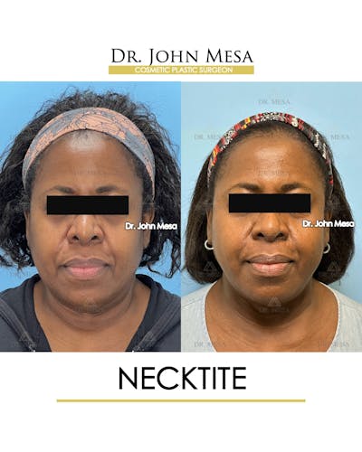 NeckTite Before & After Gallery - Patient 817200 - Image 1