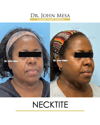 NeckTite Before & After Gallery - Patient 817200 - Image 2