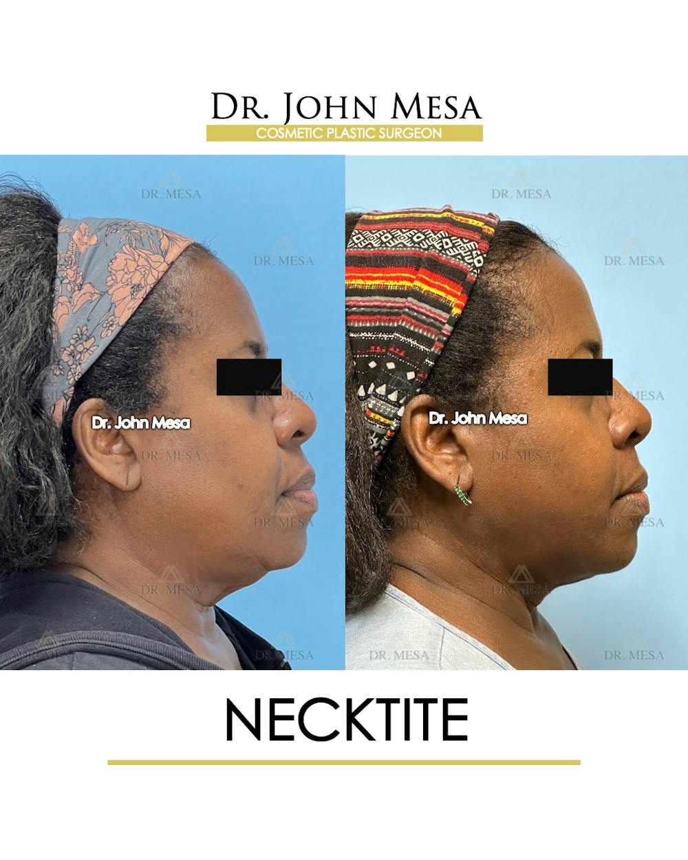NeckTite Before & After Gallery - Patient 817200 - Image 3