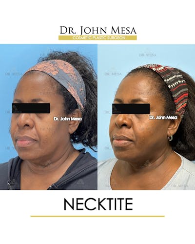 NeckTite Before & After Gallery - Patient 817200 - Image 4